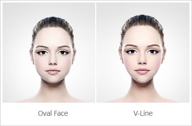 Cirurgia V-line rosto ovalado