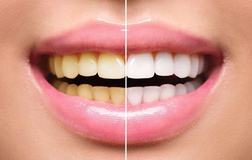 Clareamento dental natural